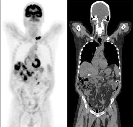 Nuclear medicine in Valencia and PET-CT in Valencia and throughout Spain. - 1