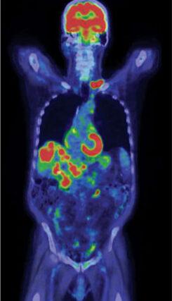 Nuclear medicine in Valencia and PET-CT in Valencia and throughout Spain. - 2