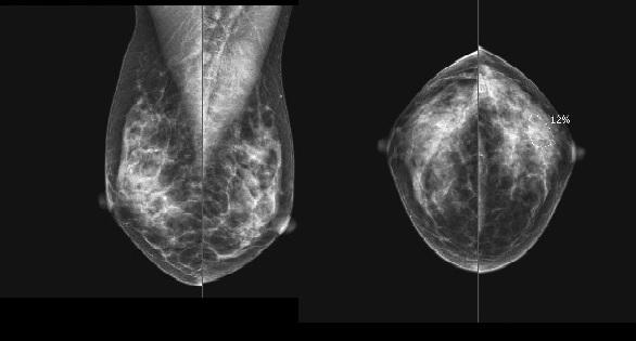 EXAMPLE OF NORMAL MAMMOGRAPHY WITHOUT PATHOLOGY