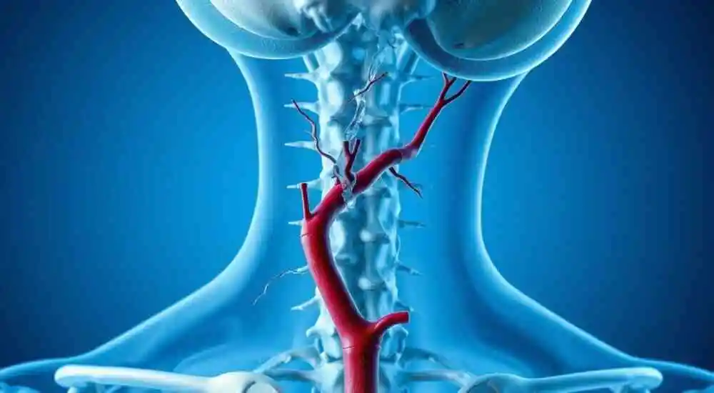 Disección de la arteria vertebral