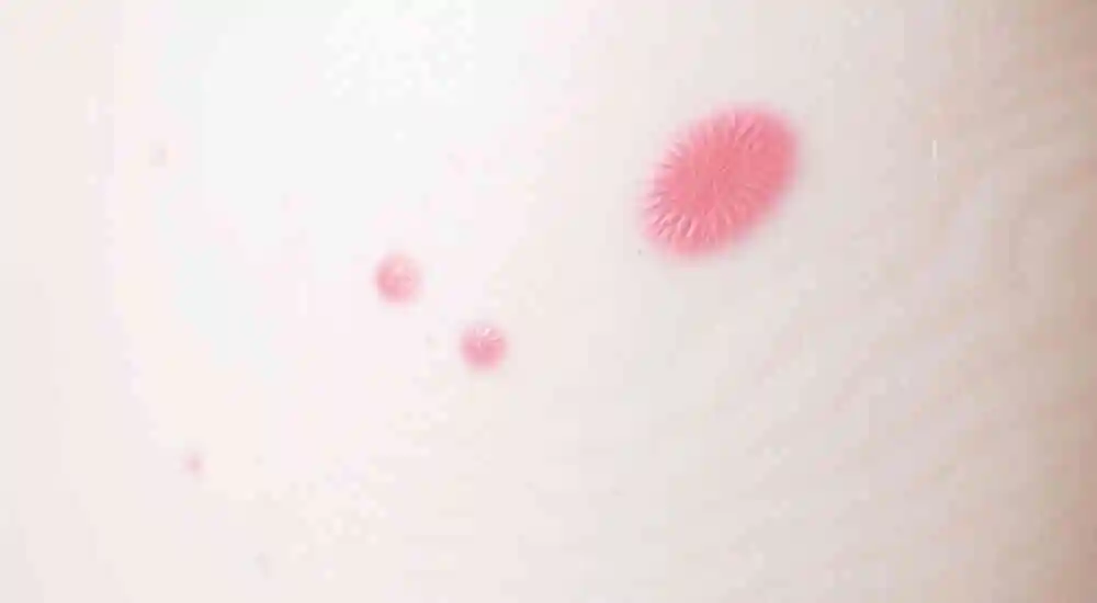 Urticaria pigmentosa