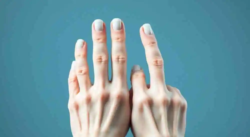 Syndactyly