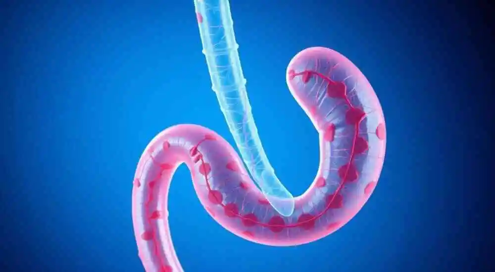 Colangitis esclerosante