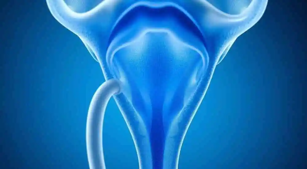 estenosis uretral