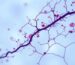 Thrombotic thrombocytopenic purpura