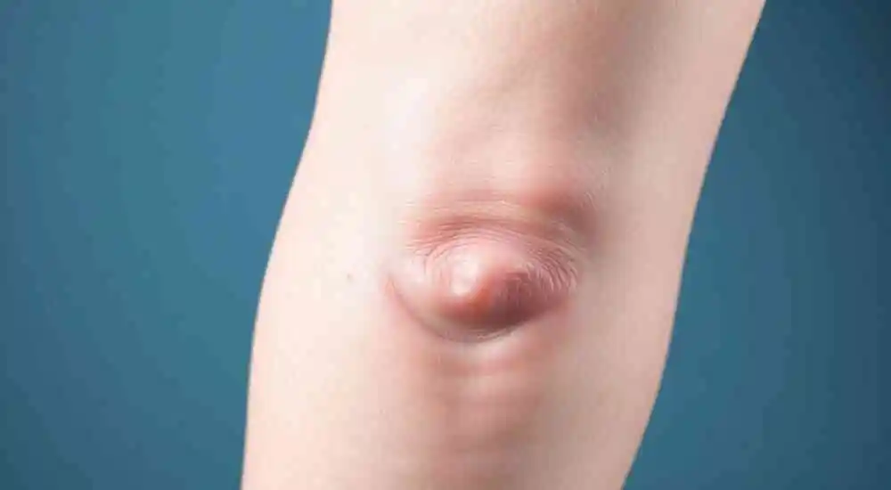 Varicose veins
