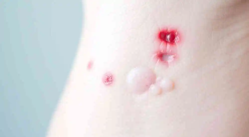 Dermatitis por estasis y úlceras.