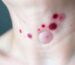 Gangrenous pyoderma