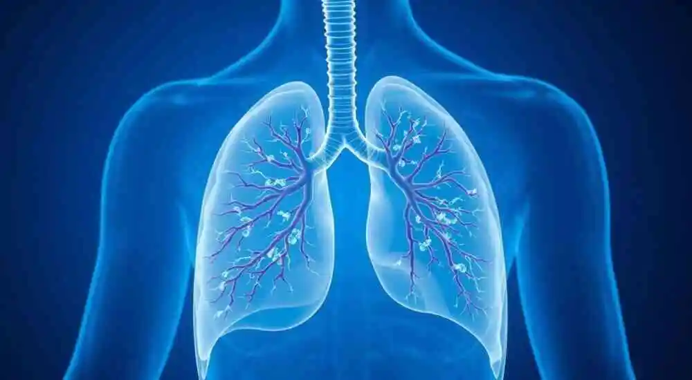 Embolia pulmonar