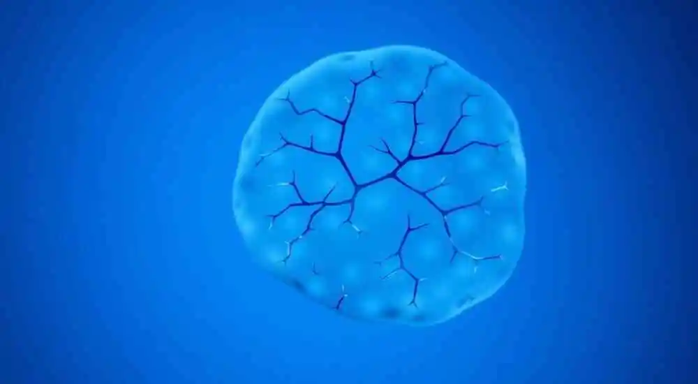 Trombosis venosa mesentérica