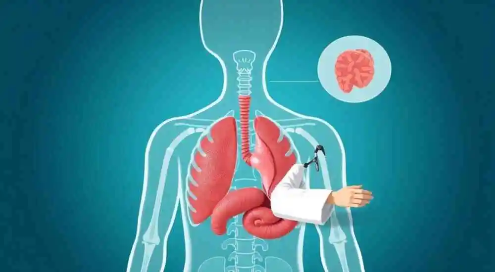 Graves' disease