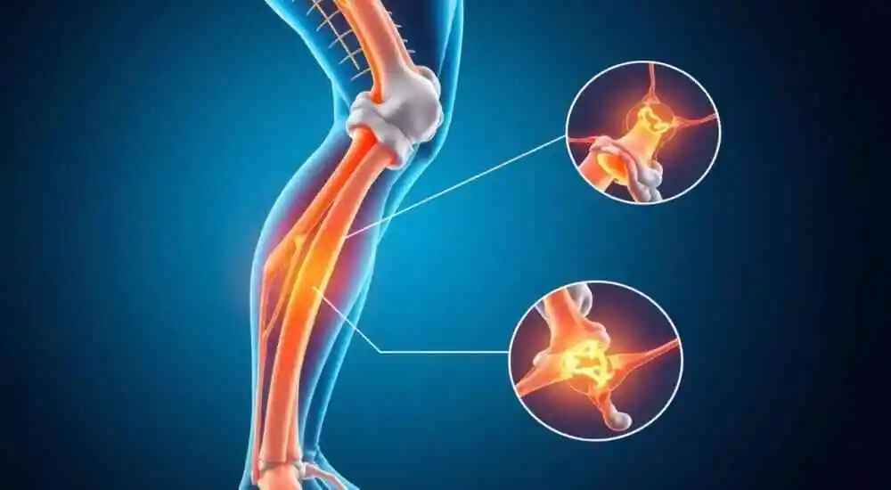 Disfunción del nervio femoral