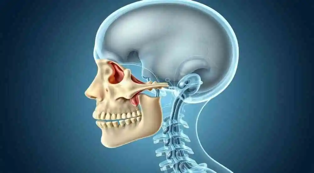 Frontometaphyseal dysplasia