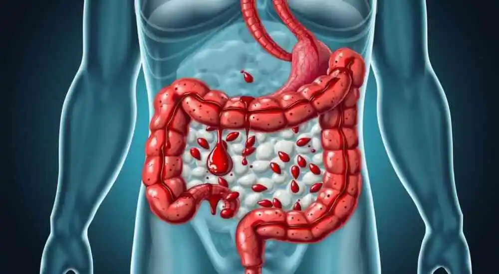 Proctocolitis hemorrágica