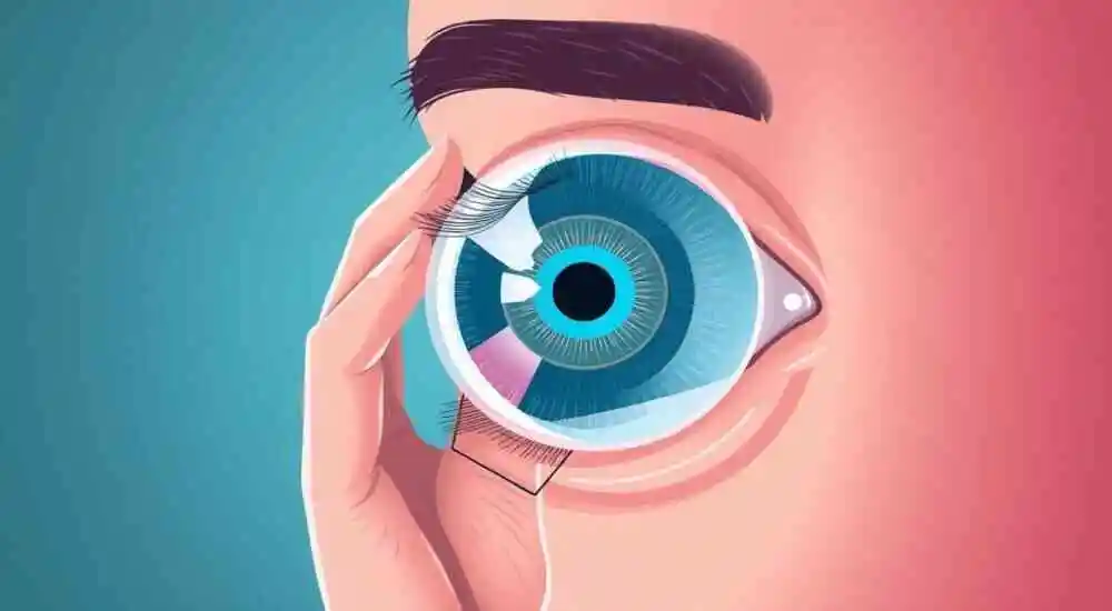 Glaucoma