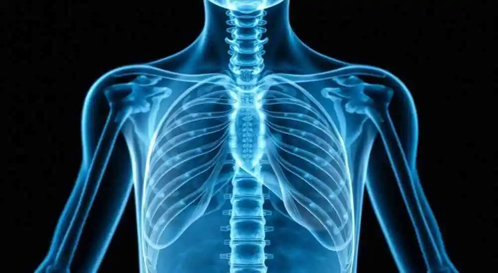 Idiopathic hypercalciuria