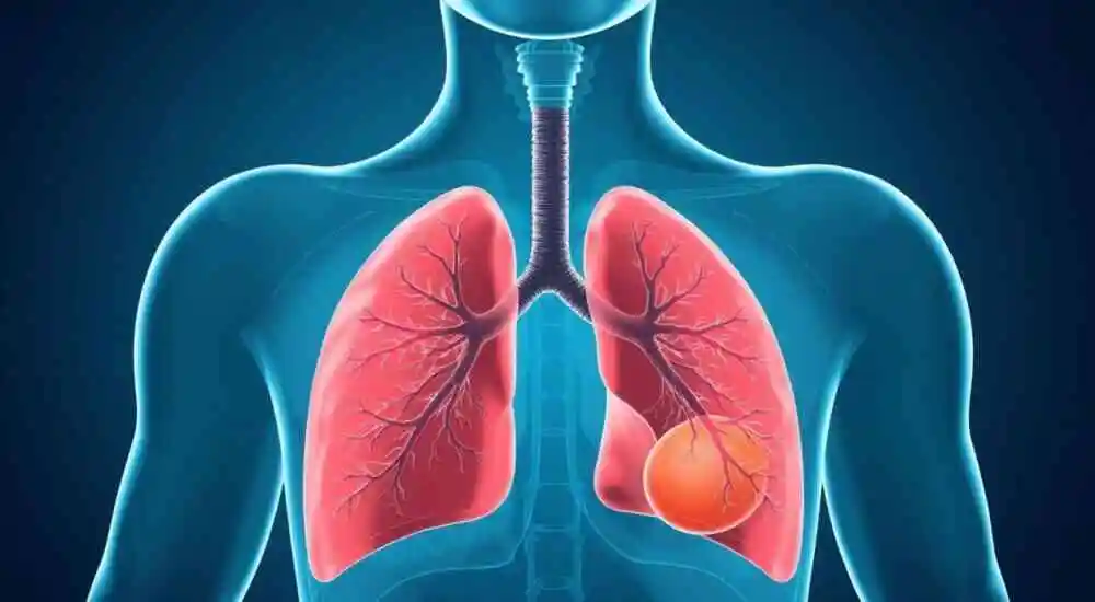 Hemosiderosis pulmonar idiopática