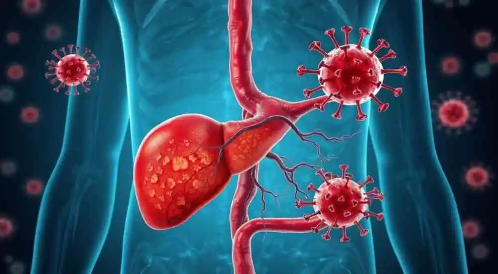 Enfermedad venooclusiva hepática con inmunodeficiencia
