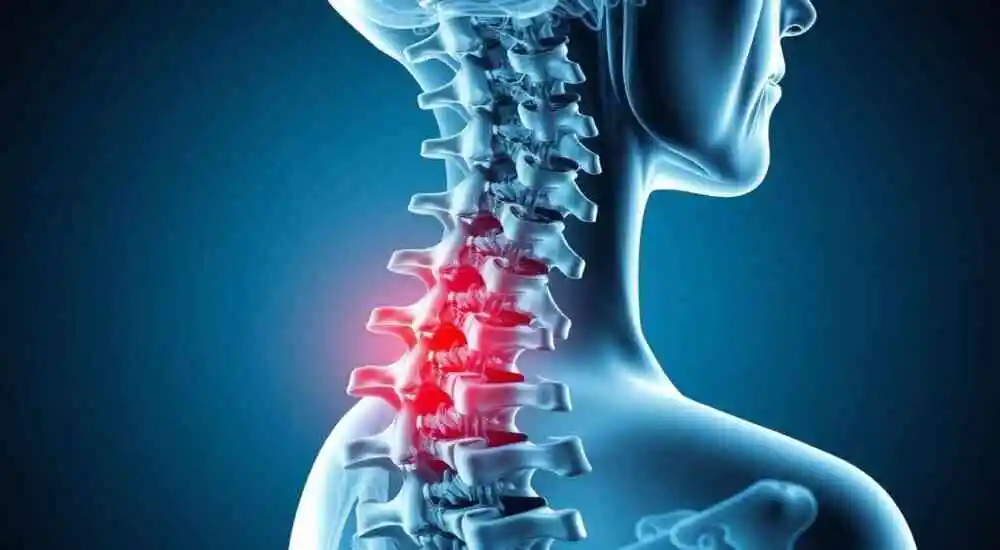 fractura de columna