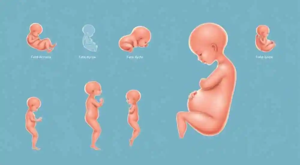 Secuencia de acinesia fetal