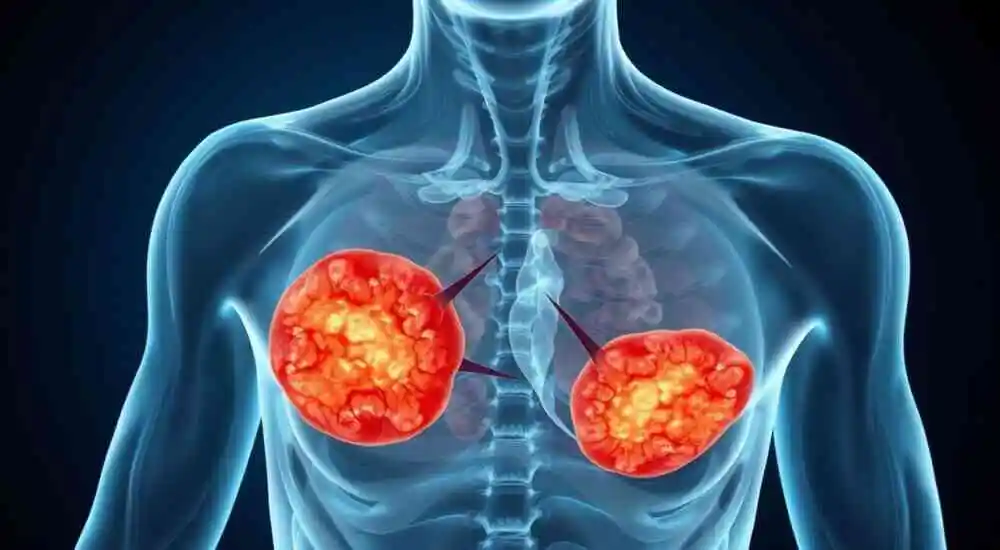 Síndrome de fibromatosis hialina