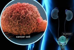 Лечение и диагностика в Валенсии рака мочевого пузыря
